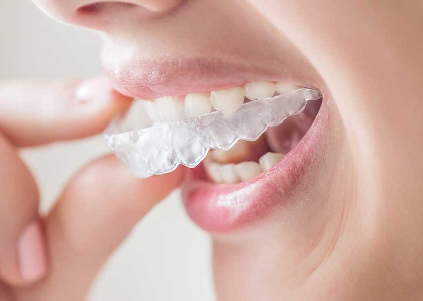 Invisible braces Air Aligner Orthodontistry Dentists Amstelveen Randwijck